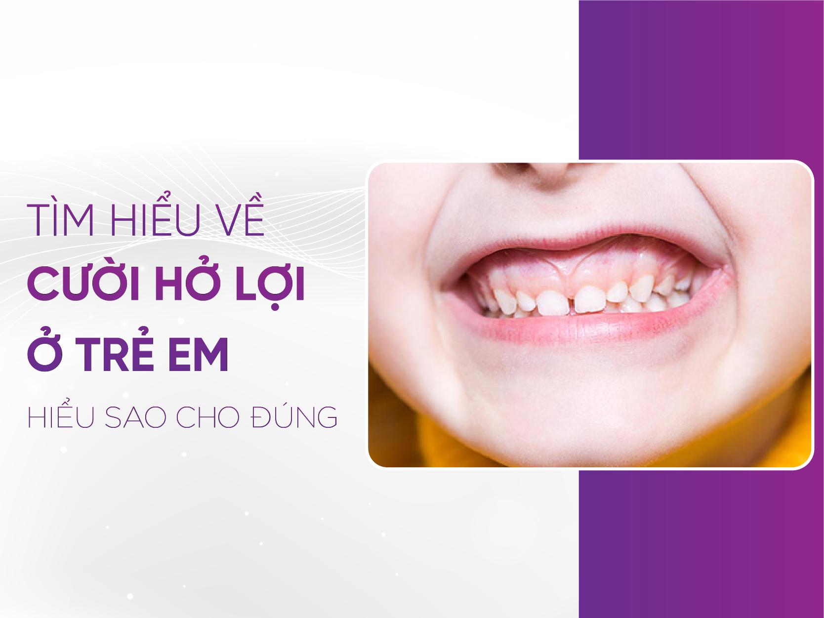 Cười Hở Lợi Trẻ Em: Nguyên Nhân, Cách Khắc Phục