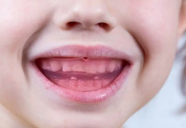 Cười hở lợi trẻ em – Giải mã nguyên nhân và khám phá giải pháp toàn diện