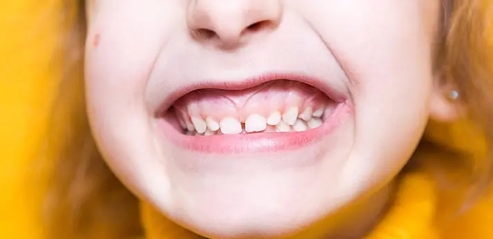 Cười hở lợi trẻ em: Nguyên nhân, cách khắc phục