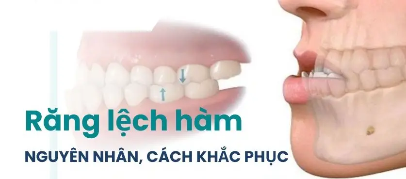 Lệch hàm có ảnh hưởng gì không - Hậu quả và Giải pháp Toàn diện