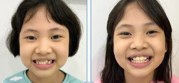 Hệ răng của bé - Trẻ có bao nhiêu răng và tầm quan trọng cho sức khỏe
