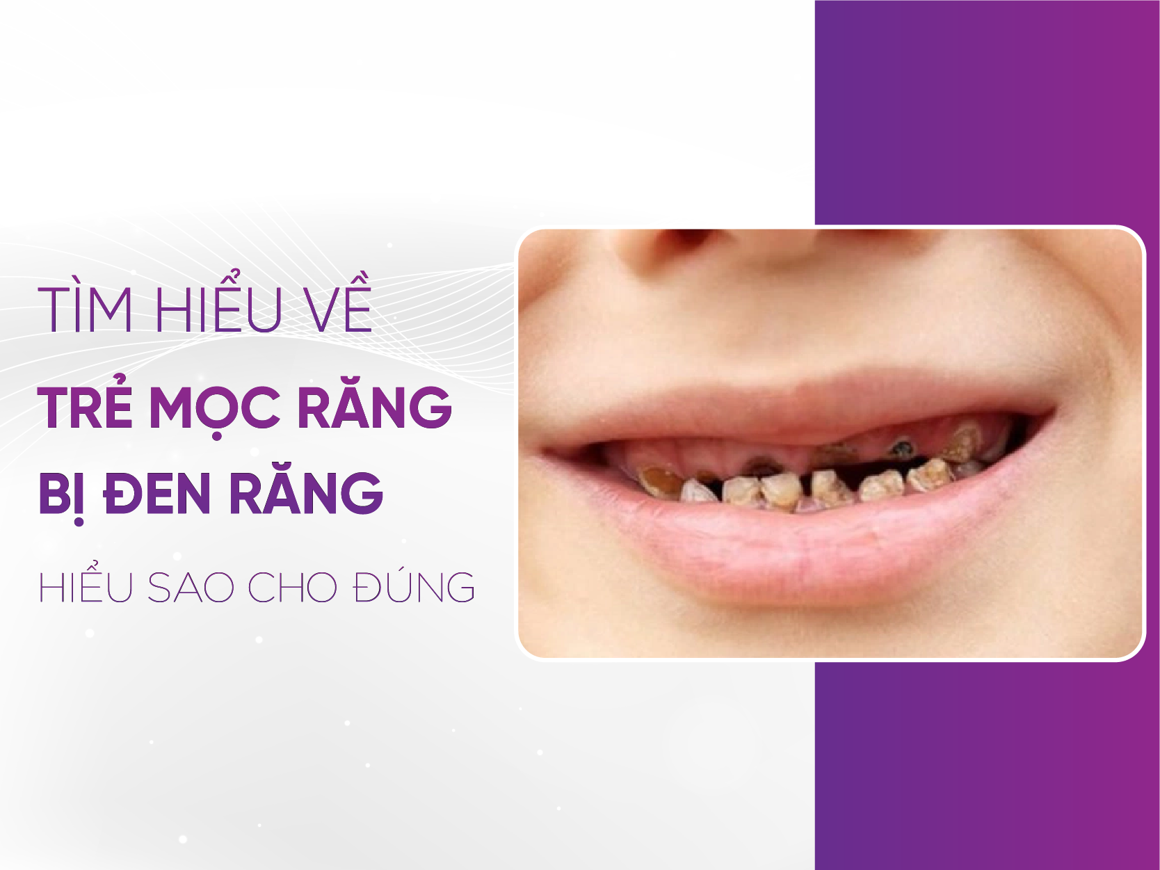 Trẻ Mọc Răng Bị Đen: Nguyên Nhân Và Cách Chăm Sóc Đúng Cách