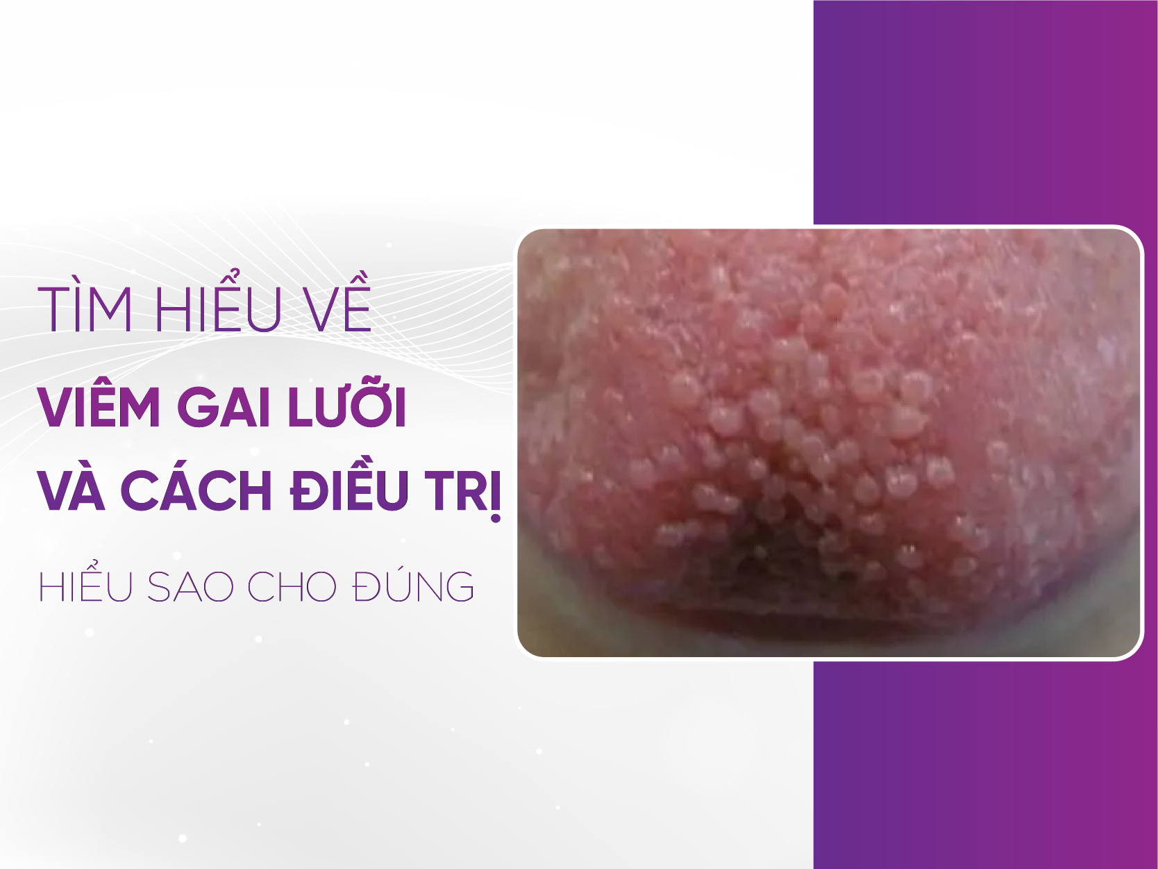 Viêm Gai Lưỡi – Giải Mã Triệu Chứng Và Bí Quyết Chữa Trị