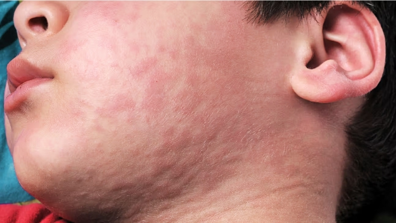 Sốc phản vệ khi nhổ răng và cách ứng phó Dấu Hiệu Nhận Biết Sốc Phản Vệ Và Quy Trình Xử Trí Cấp Cứu Tại Nha Khoa?