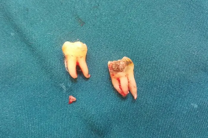 Tại sao lại xảy ra tình trạng nhổ răng khôn còn sót chân?