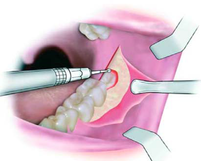 Nhổ răng mà vẫn chảy máu có sao không? Tại Sao Nhổ Răng Rồi Mà Máu Vẫn Chảy Mãi Không Ngừng?
