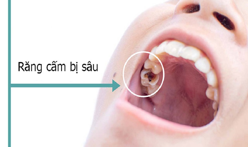 Nhổ răng cấm không trồng lại có sao không? 7 Hậu Quả Khôn Lường Khi Nhổ Răng Cấm Không Trồng Lại?