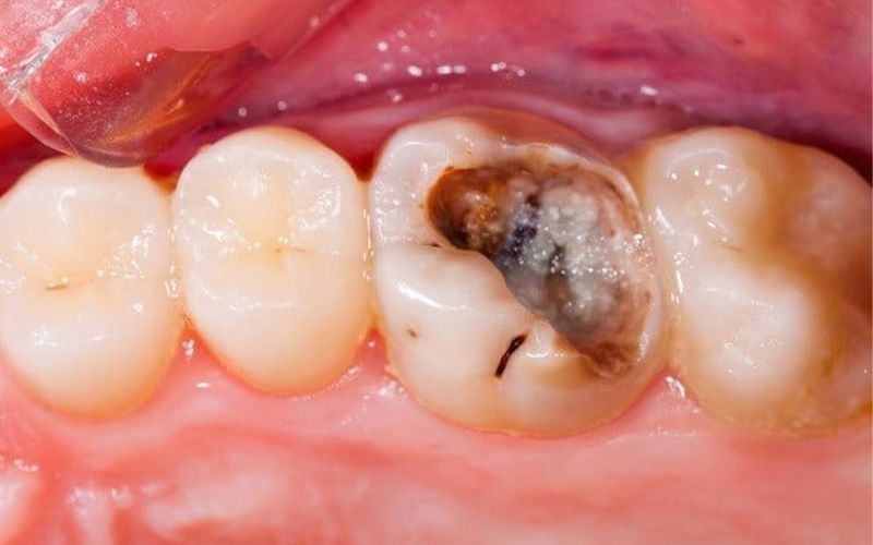 Răng cấm là răng gì? Tại Sao Răng Cấm Quan Trọng Nhất Lại Dễ Bị Hư Hỏng Nhất?