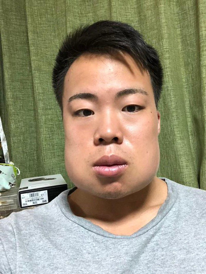 Nhổ răng khôn có làm thay đổi khuôn mặt không? Vậy, Khi Nào Nhổ Răng Khôn Thực Sự Có Thể Làm Thay Đổi Khuôn Mặt?