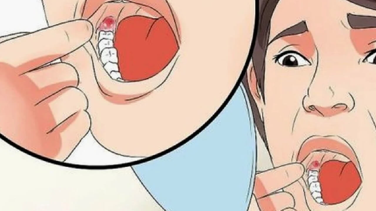 Nhổ răng mà vẫn chảy máu có sao không? Âu Là Chảy Máu Bình Thường Và Đâu Là Chảy Máu Bất Thường Sau Khi Nhổ Răng?