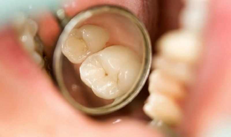 Răng cấm là răng gì? Tại Sao Răng Cấm Lại Giữ Vai Trò Sống Còn Trên Cung Hàm?