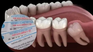 Thủ Tục Và Quy Trình Nhổ Răng Bằng Bảo Hiểm Y Tế?