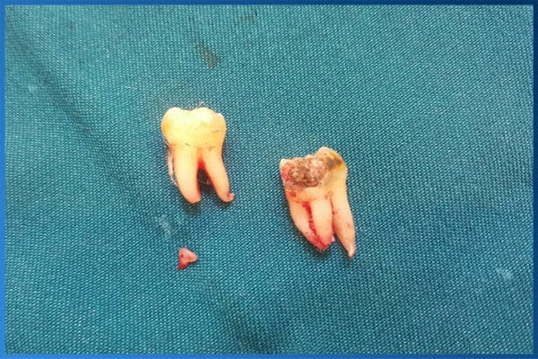 Nhổ Răng Khôn 1 Lần Được Mấy Cái