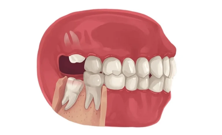 Liệu Có Trường Hợp Nào Có Thể An Toàn Giữ Lại Răng Khôn Không?