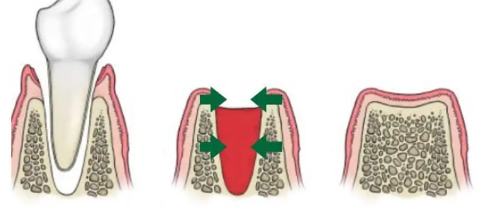 Quá Trình Lành Thương Sau Khi Nhổ Răng