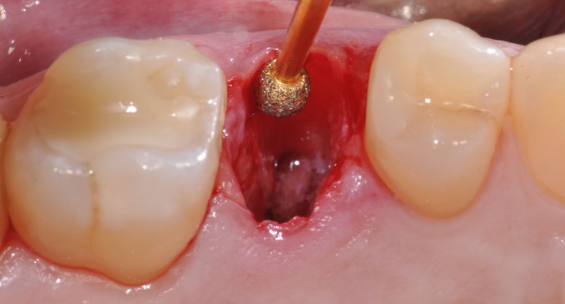 Lỗ Nhổ Răng Khôn Bao Lâu Thì Đầy Lại Hoàn Toàn?