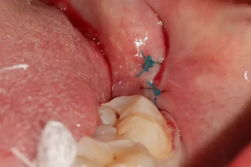 Quá Trình Lành Thương Sau Khi Nhổ Răng