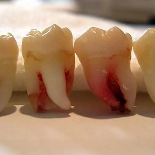 Nhổ răng khôn được nghỉ mấy ngày? Nhổ Răng Khôn Được Nghỉ Mấy Ngày