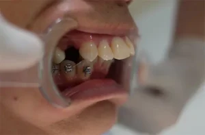 Những Rủi Ro Nguy Hiểm Nào Nếu Cố Chấp Không Nhổ Răng Khi Đã Có Chỉ Định?