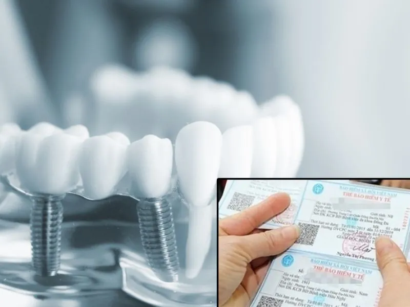 Nhổ răng có được bảo hiểm y tế không? Những Lưu Ý Quan Trọng Khác Khi Nhổ Răng Bằng Bhyt
