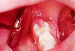 Tại Sao Răng Đang Viêm Sưng Cấp Tính Lại Không Được Nhổ?