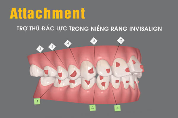 Attachment Trong Chỉnh Nha Là Gì? Attachment Trong Chỉnh Nha Là Gì Và Tại Sao Chúng Lại Quan Trọng?