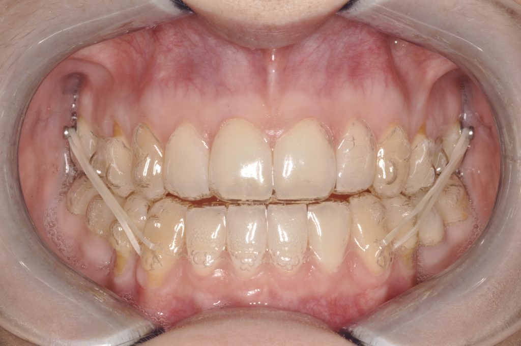 Attachment Trong Chỉnh Nha Là Gì? Quy Trình Gắn Và Tháo Attachment Diễn Ra Như Thế Nào?