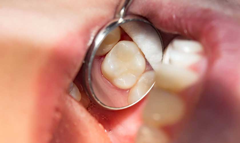 Ê buốt sau trám răng? 5 Nguyên Nhân & Cách Xử Trí Từ Chuyên Gia Phải Làm Gì Để Giảm Ê Buốt Sau Khi Trám Răng Tại Nhà?