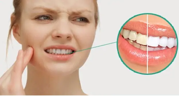 Ê Buốt Sau Tẩy Trắng Răng Kéo Dài Bao Lâu?