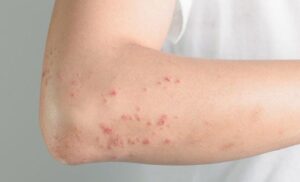 Dị Ứng Thuốc Tê