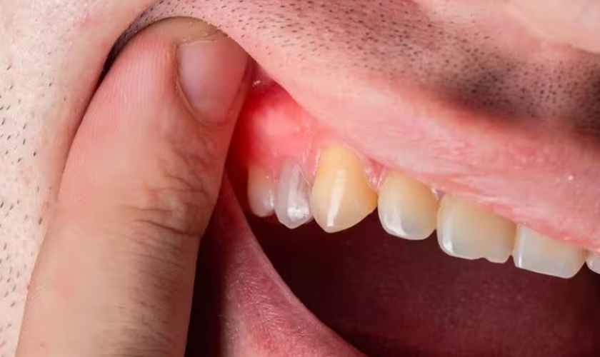 Cách Chữa Sưng Mộng Răng Tại Nhà Hiệu Quả Như Thế Nào?