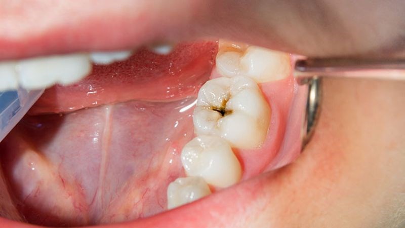 Quy Trình Trám Răng Bằng Mta Diễn Ra Như Thế Nào?