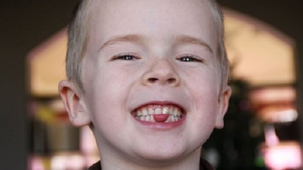 Tật Đẩy Lưỡi Ở Trẻ: Cảnh Báo Nguy Cơ Răng Hô Và Lệch Khớp Cắn?