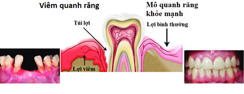 Bệnh Viêm Chân Răng Được Chẩn Đoán Và Điều Trị Như Thế Nào?