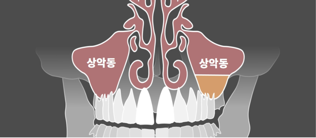 Thủng Xoang Hàm Là Gì?