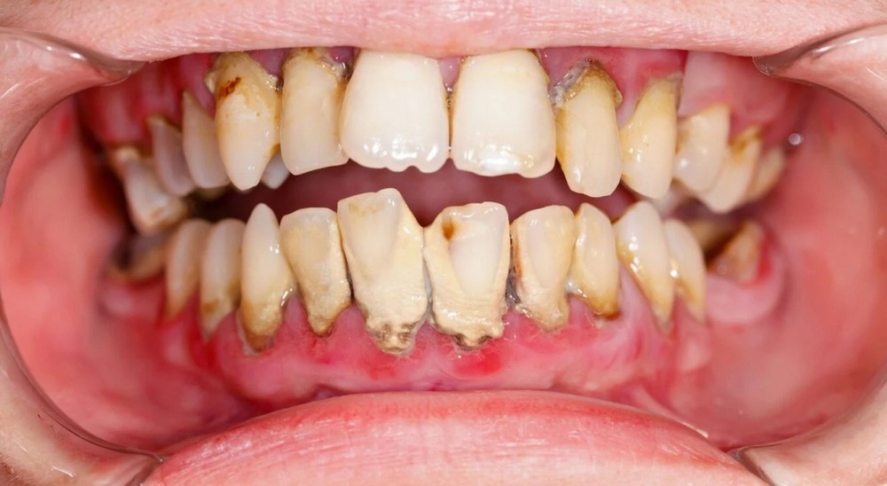 Bệnh Viêm Chân Răng: Nguyên Nhân, Triệu Chứng, Điều Trị Và Phòng Ngừa Hiệu Quả