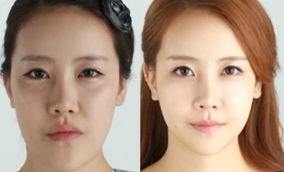 Nguyên Nhân Lệch Hàm Là Gì?