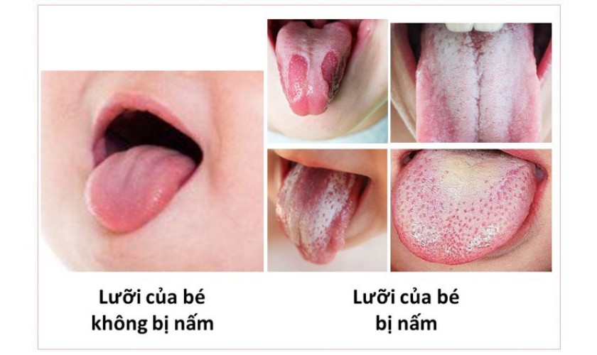 10+ Các Bệnh Về Lưỡi Ở Trẻ Thường Gặp: Cha Mẹ Tuyệt Đối Chớ Chủ Quan