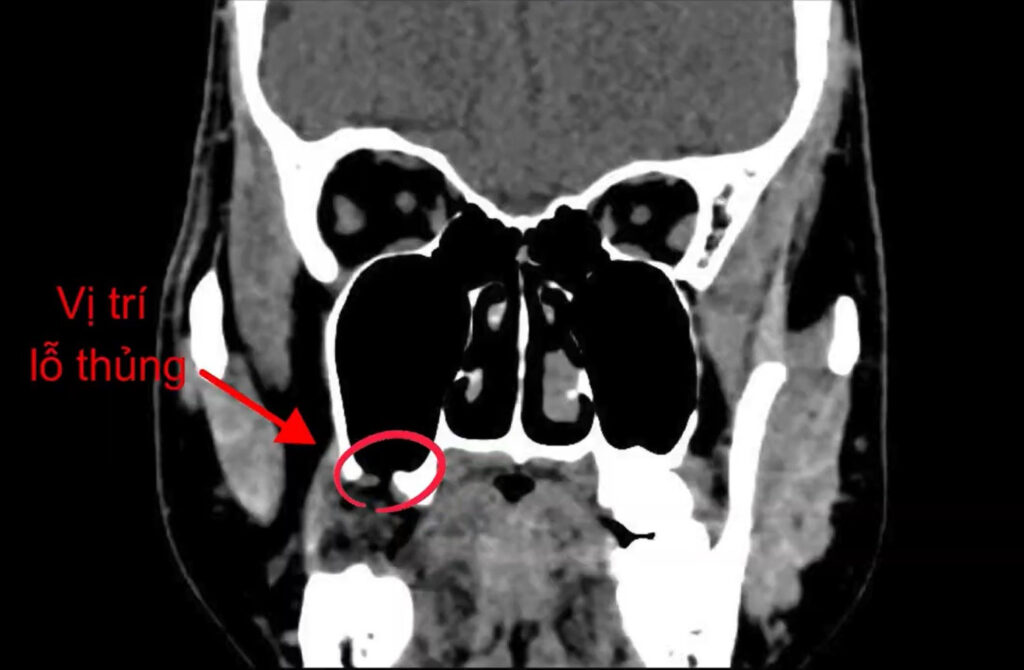Thủng Xoang Hàm Là Gì?
