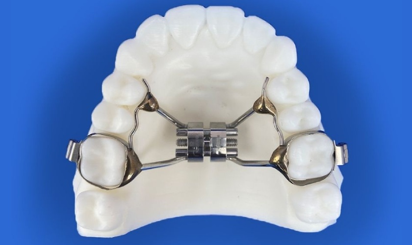 Khí Cụ Nong Hàm: Giải Pháp Hiệu Quả Cho Hàm Hẹp Và Sai Khớp Cắn