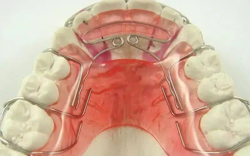 Khí Cụ Nong Hàm Tháo Lắp Hoạt Động Như Thế Nào?