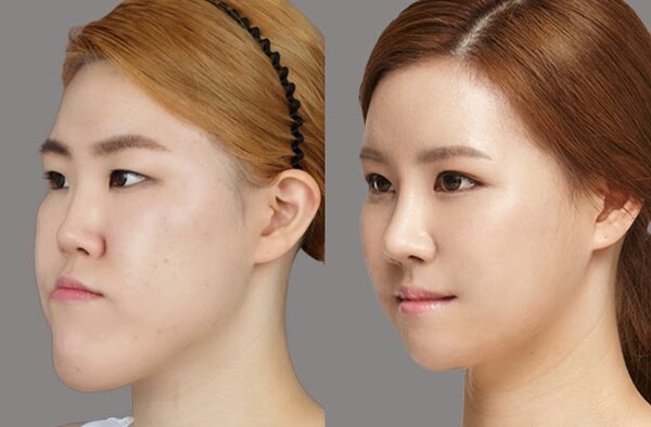 Nguyên Nhân Lệch Hàm Là Gì?