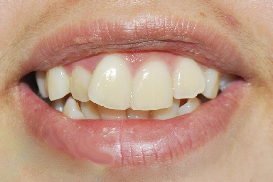 Có Nên Mài Răng Hô Để Làm Đẹp Nhanh Không?