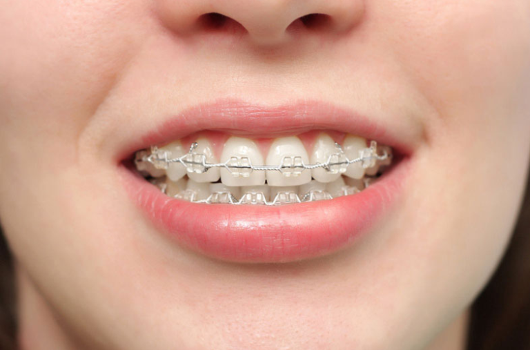 Niềng Răng Có Ảnh Hưởng Đến Thần Kinh Không? Sự Thật Và Lời Khuyên Bác Sĩ