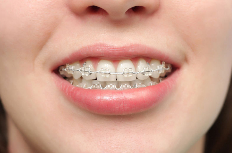 Niềng Răng Có Ảnh Hưởng Đến Thần Kinh Không? Sự Thật Và Lời Khuyên Bác Sĩ