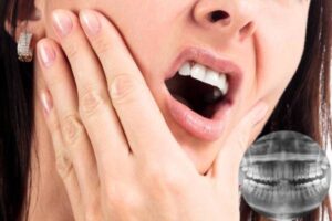 Răng Hàm Cắn Vào Má