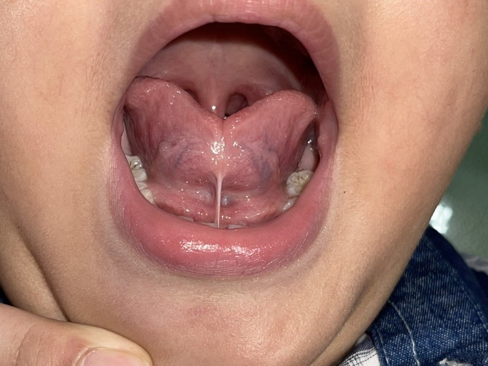 Phanh Lưỡi Là Gì? Những Sự Thật Bạn Nhất Định Phải Biết Dính Thắng Lưỡi - Bệnh Lý Thường Gặp Nhất Ở Phanh Lưỡi Là Gì?