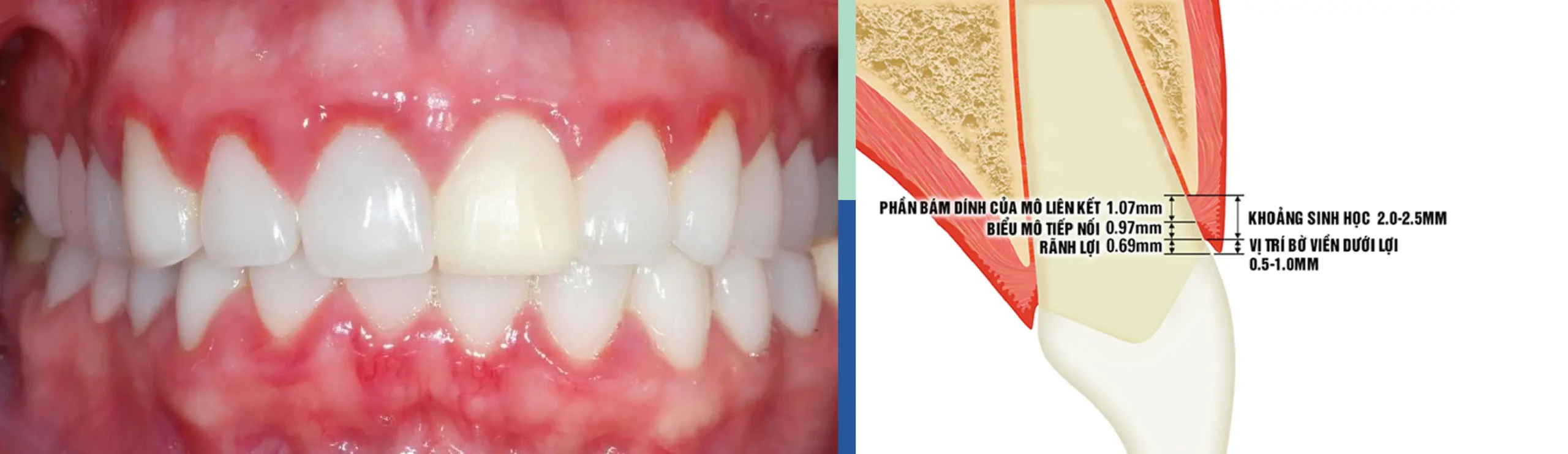 Viêm Lợi Sau Khi Bọc Răng Sứ: Nguyên Nhân Và 5 Cách Xử Lý Dấu Hiệu Nhận Biết Bạn Đang Bị Viêm Lợi Sau Khi Bọc Răng Sứ?