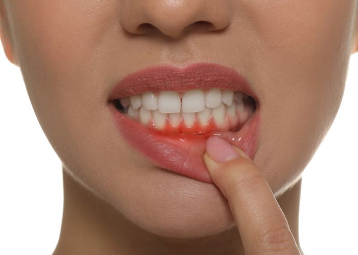 Viêm Lợi Sau Khi Bọc Răng Sứ: Nguyên Nhân Và 5 Cách Xử Lý Viêm Lợi Sau Khi Bọc Răng Sứ Là Gì Và Tại Sao Nó Lại Xảy Ra