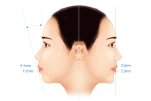 Cằm Lẹm Là Gì? 5 Giải Pháp &Quot;Lột Xác&Quot; Góc Nghiêng Thần Thánh